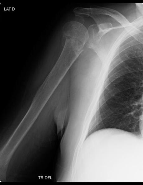 fractura del  cuello quirúrgico del húmero