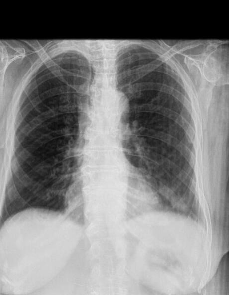 DATOS DE NEUMOPATÍA CRÓNICA INTERSTICIAL