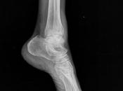 Fractura maléolo lateral trazo oblicuo inferior superior sindesmosis, desplazada edema asociado (wéber tipo