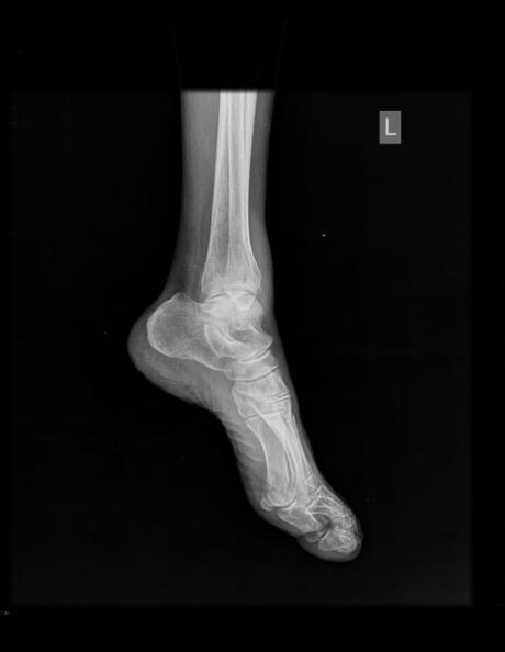 FRACTURA DE MALÉOLO LATERAL POR TRAZO OBLICUO DE INFERIOR A SUPERIOR A SINDESMOSIS, NO DESPLAZADA CON EDEMA ASOCIADO (WÉBER TIPO B)