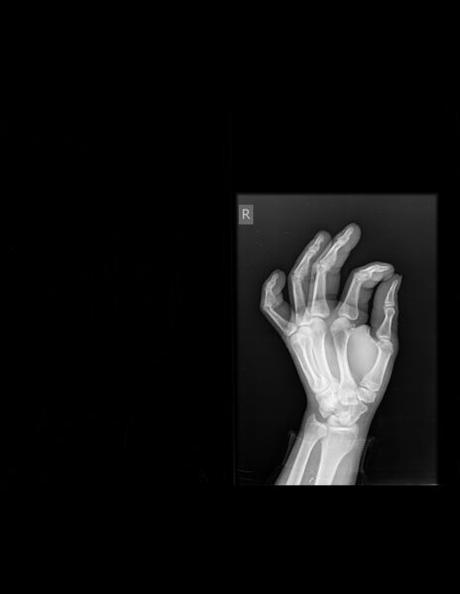 FRACTURA A NIVEL DE CINTURA DE ESCAFOIDES, TIPO A-2 EN CLASIFICACIÓN DE HERBERT Y FISHER