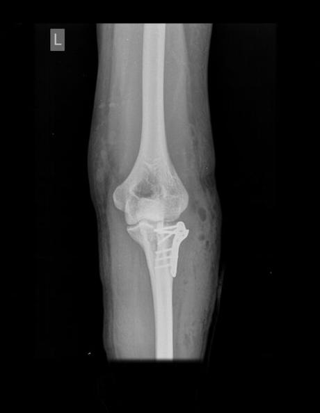 A NIVEL DE RADIO DISTAL CON MATERIAL DE OSTEOSÍNTESIS CON ADECUADA COLOCACIÓN Y EDEMA PERIFÉRICO ASOCIADO