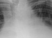 Existe derrame pleural bilateral predominio derecho redistribución vascular cefálica