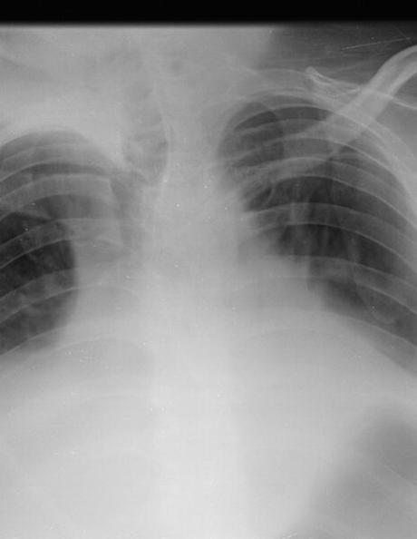 EXISTE DERRAME PLEURAL BILATERAL DE PREDOMINIO DERECHO Y REDISTRIBUCIÓN VASCULAR CEFÁLICA