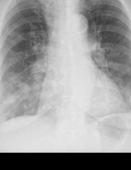 NEUMOPATÍA CRÓNICA INTERSTICIAL Y PROCESO NEUMÓNICO DE FOCOS MÚLTIPLES AGREGADO