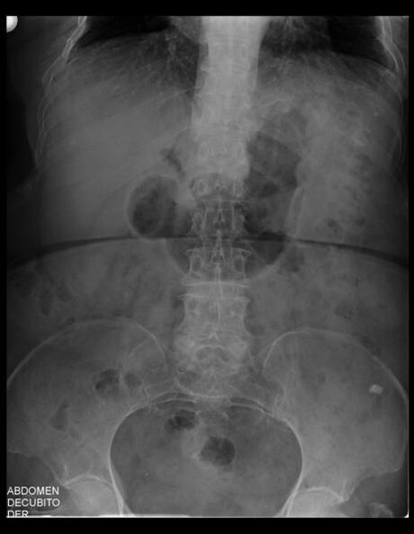 CALCIFICACIÓN EN TOPOGRAFÍA RENAL DERECHA QUE PODRÍA CORRESPONDER A UN LITO.