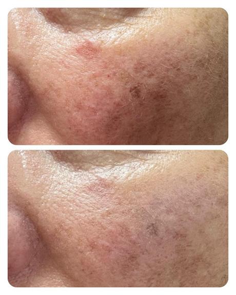 BIO19FORTE-DESPIGMENTANTE-BELLAAURORA BIO19FORTE-DESPIGMENTANTE-BELLAAURORA