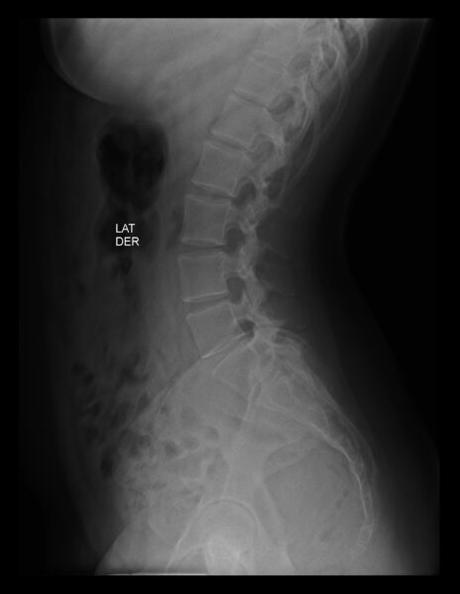 SACRALIZACIÓN DE L5 CASTELLVI TIPO IV