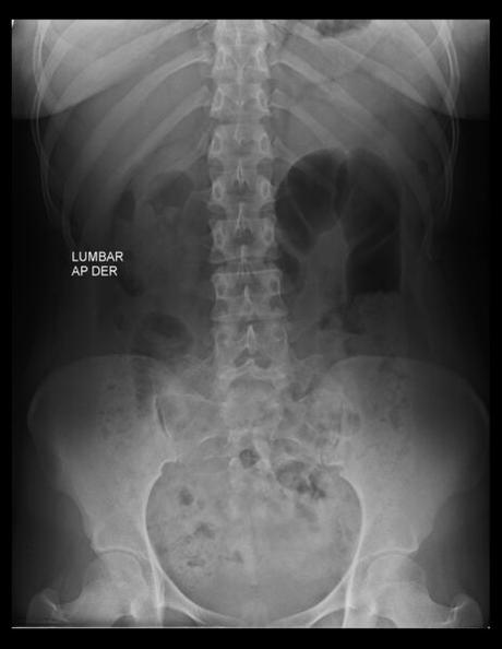 SACRALIZACIÓN DE L5 CASTELLVI TIPO IV
