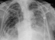 Datos neumopatía crónica intersticial proceso neumónico basal bilateral derrame pleural bilateral, predominio izquierdo