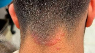 Qué es la tiña, la infección que afecta a la piel: síntomas, causas y tratamiento