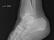 (fractura tobillo derecho wéber tipo fractura izquierdo