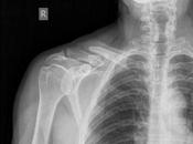 Fractura antigua entre tercio distal medio clavícula derecha desplazamiento inferior