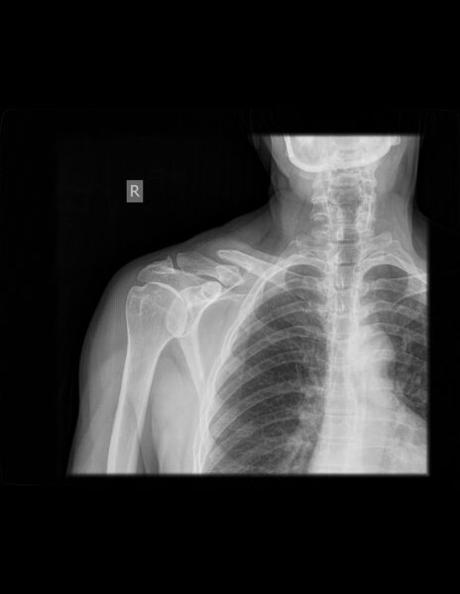 FRACTURA ANTIGUA ENTRE EL TERCIO DISTAL Y MEDIO DE CLAVÍCULA DERECHA CON DESPLAZAMIENTO INFERIOR