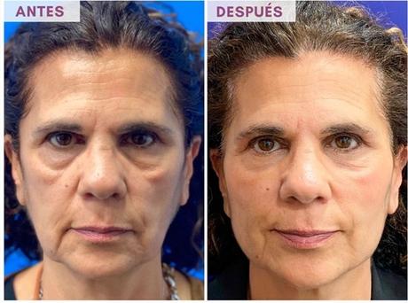 Rejuvenecimiento facial con bioestimuladores en Clínica Menorca: belleza natural sin excesos Rejuvenecimiento facial con bioestimuladores en Clínica Menorca: belleza natural sin excesos