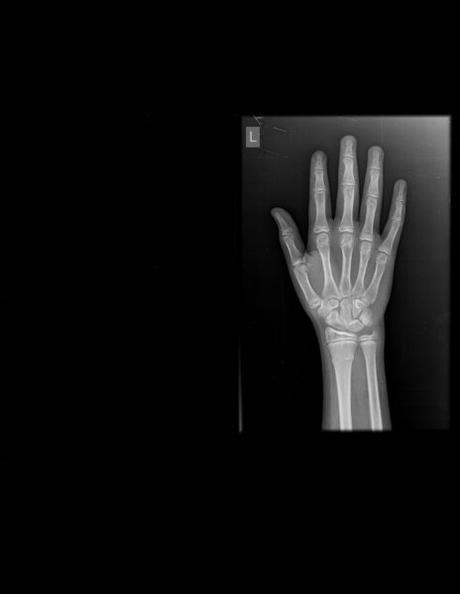 FRACTURA TIPO TORUS A NIVEL DE METÁFISIS DE RADIO DISTAL