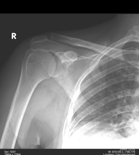 ELEVACIÓN DE CLAVÍCULA MENOR AL 25%. (ROCKWOOD TIPO II)