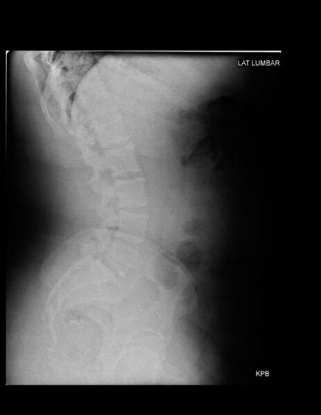 APARENTE DISCARTROSIS Y ESTENOSIS DE NEURO FORAMEN DE L5-S1, ESTO POR SACRALIZACIÓN DE L5