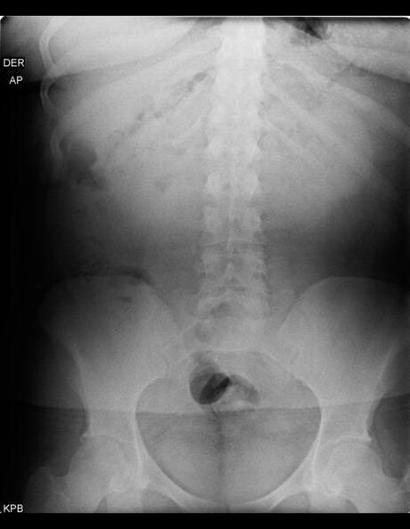 APARENTE DISCARTROSIS Y ESTENOSIS DE NEURO FORAMEN DE L5-S1, ESTO POR SACRALIZACIÓN DE L5