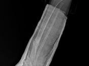 Ractura nivel distal tibia peroné fases consolidación, cuales presentan leve angulación anteromedial