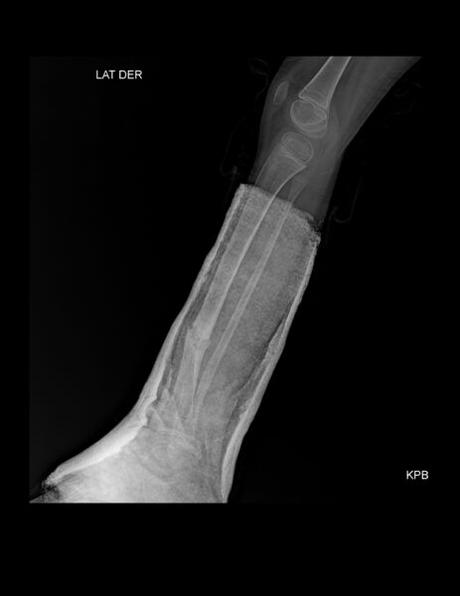 RACTURA A NIVEL DISTAL DE TIBIA Y PERONÉ EN FASES DE CONSOLIDACIÓN, LAS CUALES PRESENTAN LEVE ANGULACIÓN ANTEROMEDIAL