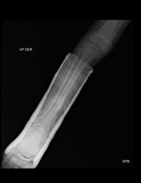 RACTURA A NIVEL DISTAL DE TIBIA Y PERONÉ EN FASES DE CONSOLIDACIÓN, LAS CUALES PRESENTAN LEVE ANGULACIÓN ANTEROMEDIAL