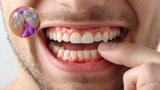 Cómo desinflamar las encías: desde una buena dieta a evitar el picante