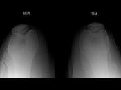 Datos sugerentes subluxación ambas rodillas