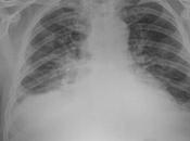 Reforzamiento parahiliar bilateral, descartar origen cardiogénico