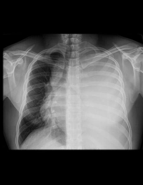 DERRAME PLEURAL IZQUIERDO MASIVO, CONDICIONANDO DESPLAZAMIENTO DERECHO DE MEDIASTINO
