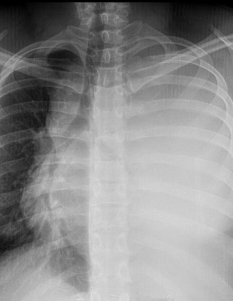 DERRAME PLEURAL IZQUIERDO MASIVO, CONDICIONANDO DESPLAZAMIENTO DERECHO DE MEDIASTINO