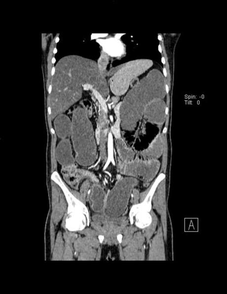 OBSTRUCCIÓN DE INTESTINO DELGADO A NIVEL DE ÍLEON (DE ORIGEN A DETERMINAR), ALGUNOS SITIOS CON EDEMA, SIN DESCARTAR PROCESO ISQUÉMICO