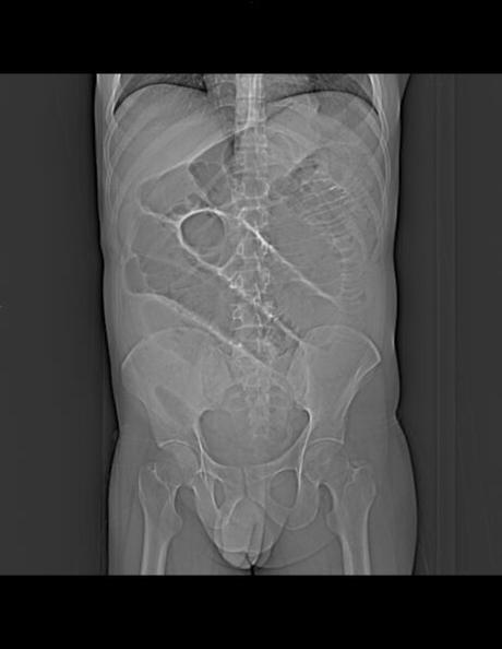 OBSTRUCCIÓN DE INTESTINO DELGADO A NIVEL DE ÍLEON (DE ORIGEN A DETERMINAR), ALGUNOS SITIOS CON EDEMA, SIN DESCARTAR PROCESO ISQUÉMICO
