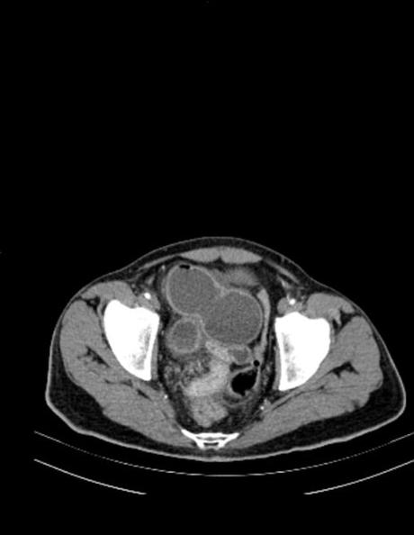 OBSTRUCCIÓN DE INTESTINO DELGADO A NIVEL DE ÍLEON (DE ORIGEN A DETERMINAR), ALGUNOS SITIOS CON EDEMA, SIN DESCARTAR PROCESO ISQUÉMICO