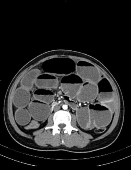 OBSTRUCCIÓN DE INTESTINO DELGADO A NIVEL DE ÍLEON (DE ORIGEN A DETERMINAR), ALGUNOS SITIOS CON EDEMA, SIN DESCARTAR PROCESO ISQUÉMICO