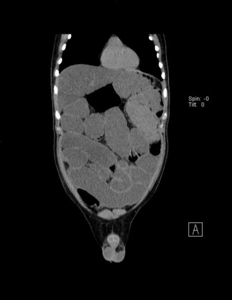 OBSTRUCCIÓN DE INTESTINO DELGADO A NIVEL DE ÍLEON (DE ORIGEN A DETERMINAR), ALGUNOS SITIOS CON EDEMA, SIN DESCARTAR PROCESO ISQUÉMICO
