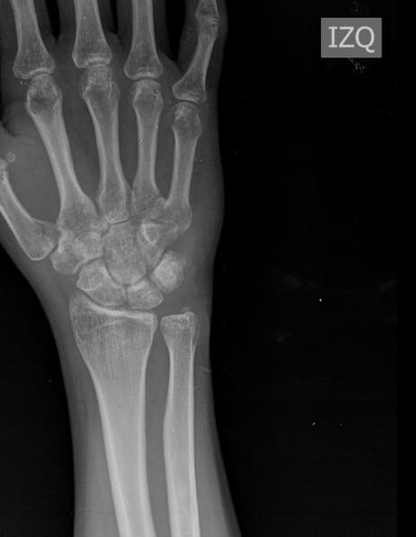 aparente fractura en porción dorsal de semilunar