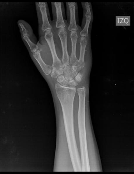 aparente fractura en porción dorsal de semilunar