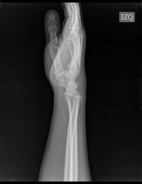 aparente fractura en porción dorsal de semilunar