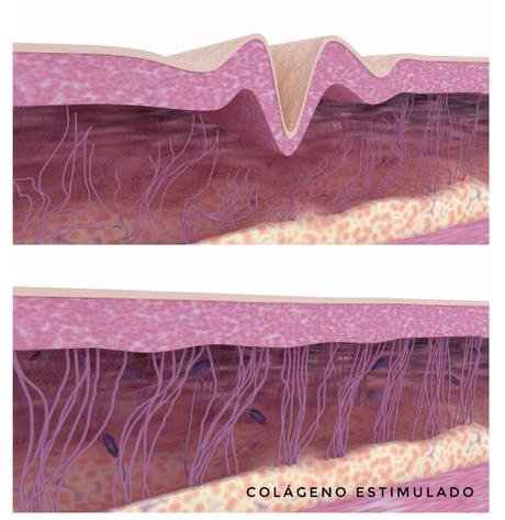 Bioestimuladores de colágeno Bioestimulación radiesse hifu marcas faciales radiesse sculptra radiofrecuencia pixelada micro Argentina inyectable antes y después precio Bioestimuladores de colágeno Bioestimulación radiesse hifu marcas faciales radiesse sculptra radiofrecuencia pixelada micro Argentina inyectable antes y después precio