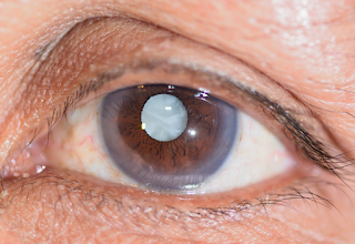 Acerca de prevenir las cataratas.