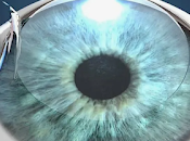 Cirugía refractiva glaucoma.