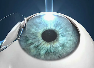 Cirugía refractiva y glaucoma.