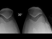 Artroplastia rodilla izquierda.