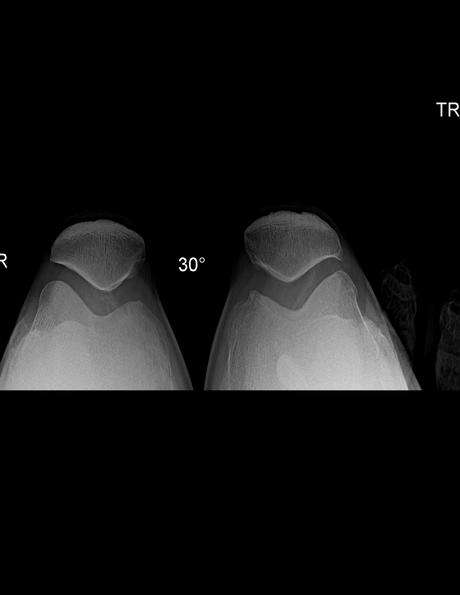 ARTROPLASTIA EN RODILLA IZQUIERDA.