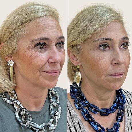 Resultados visibles, sin bisturí: las técnicas de medicina estética con las que te ves mejor sin necesidad de cirugía y sin perder la naturalidad Resultados visibles, sin bisturí: las técnicas de medicina estética con las que te ves mejor sin necesidad de cirugía y sin perder la naturalidad