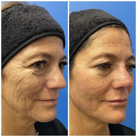 Resultados visibles, sin bisturí: las técnicas de medicina estética con las que te ves mejor sin necesidad de cirugía y sin perder la naturalidad Resultados visibles, sin bisturí: las técnicas de medicina estética con las que te ves mejor sin necesidad de cirugía y sin perder la naturalidad