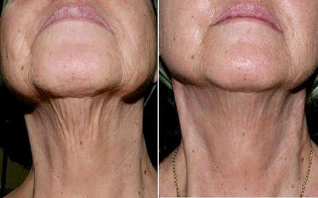 Resultados visibles, sin bisturí: las técnicas de medicina estética con las que te ves mejor sin necesidad de cirugía y sin perder la naturalidad Resultados visibles, sin bisturí: las técnicas de medicina estética con las que te ves mejor sin necesidad de cirugía y sin perder la naturalidad