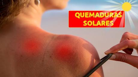 4 REMEDIOS NATURALES PARA ALIVIAR LAS QUEMADURAS SOLARES