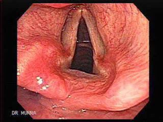 Reflujo Gastroesofágicotienen peor calidad de vida que diabéticos e hipertensos